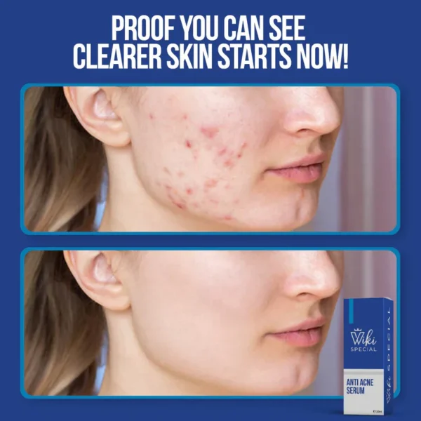 Wiki Special Anti-Acne Serum - Image 5