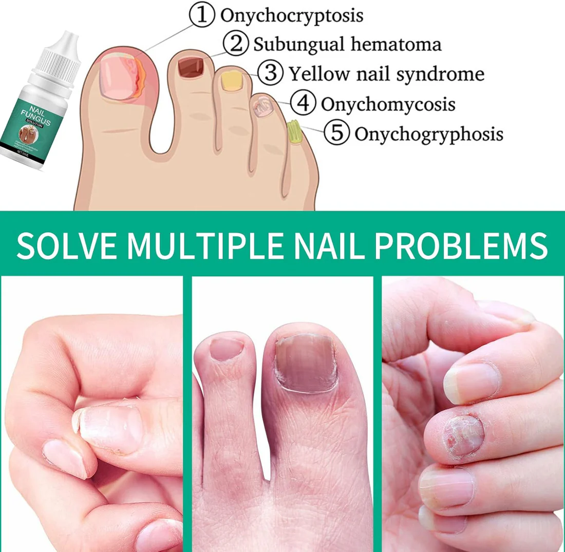 Nexusdrop Nail Fungus Solution - Image 6