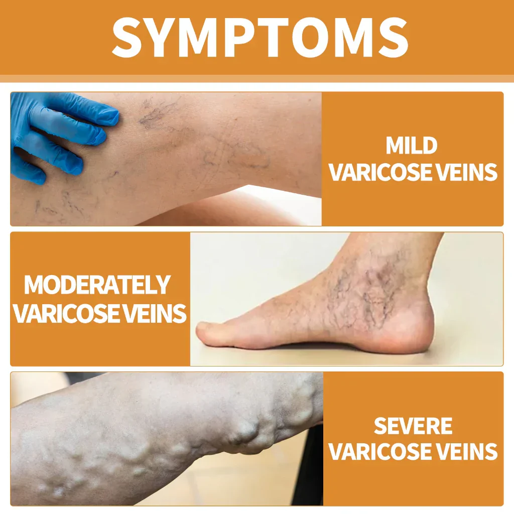 Turmeric Vericose Vein Relief Spray - Image 8