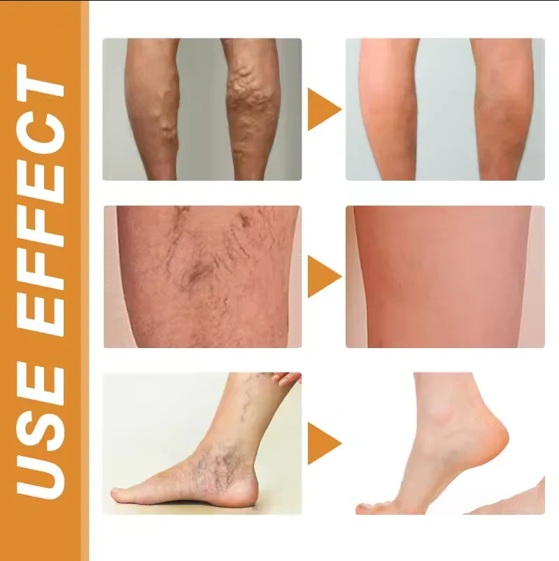 Turmeric Vericose Vein Relief Spray - Image 7