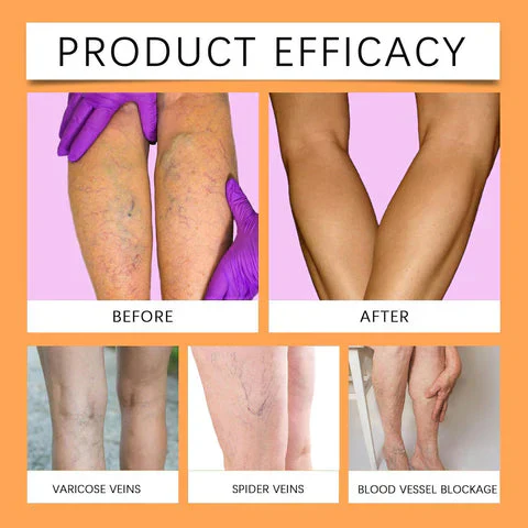 Turmeric Vericose Vein Relief Spray - Image 5