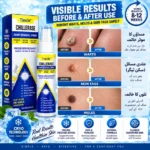 Timilk Wart & Mole Removal Spray